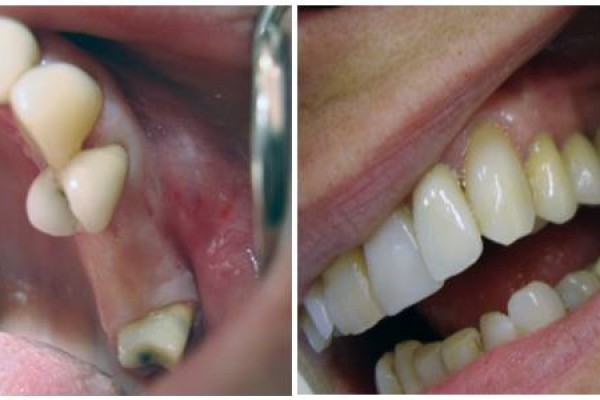 Εμφυτεύματα