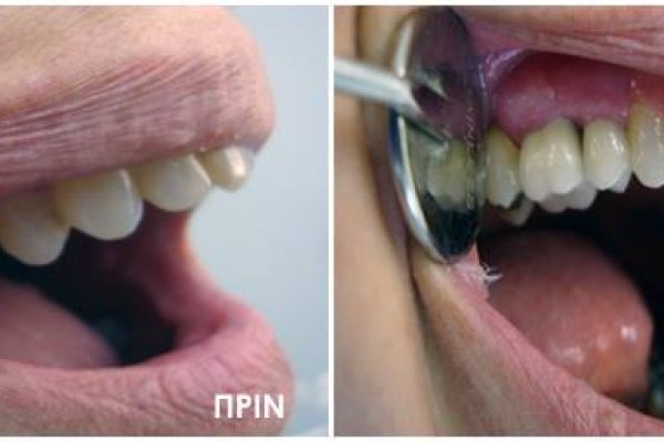 Οδοντικά Εμφυτεύματα