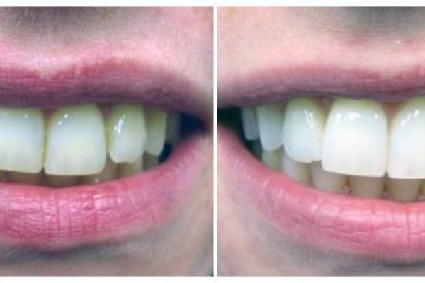 Λεύκανση δοντιών