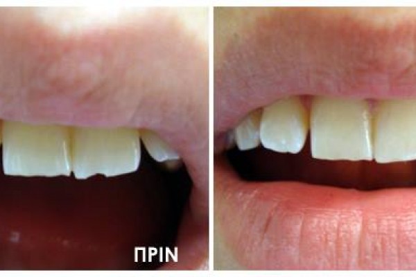 Τραύματισμός Δοντιού